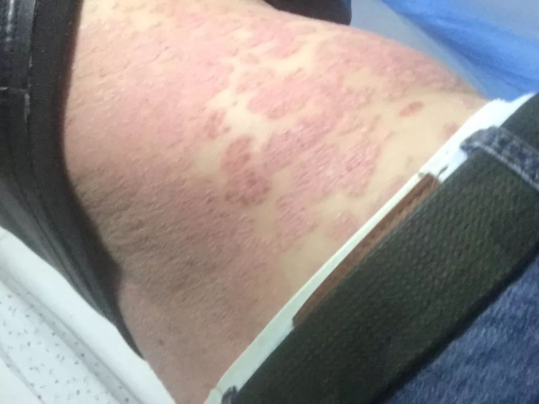 慎点！手婬牛皮癣大爆发